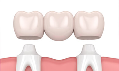 Dental Bridge