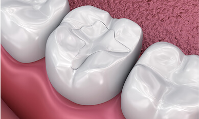 Fillings