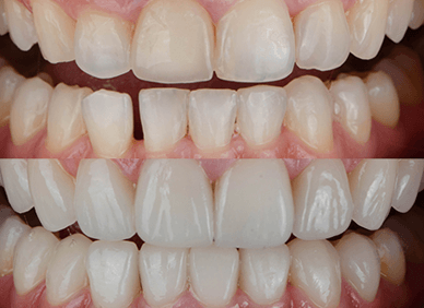 Smile Makeover