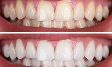 Teeth Whitening