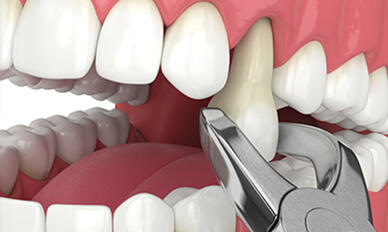 Tooth Extraction