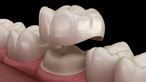 Dental Crown