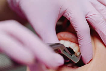 Dental Extraction