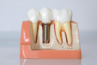 Implant Placement